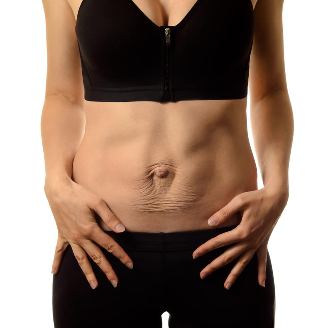 Diastază abdomnială by Glutes Lady